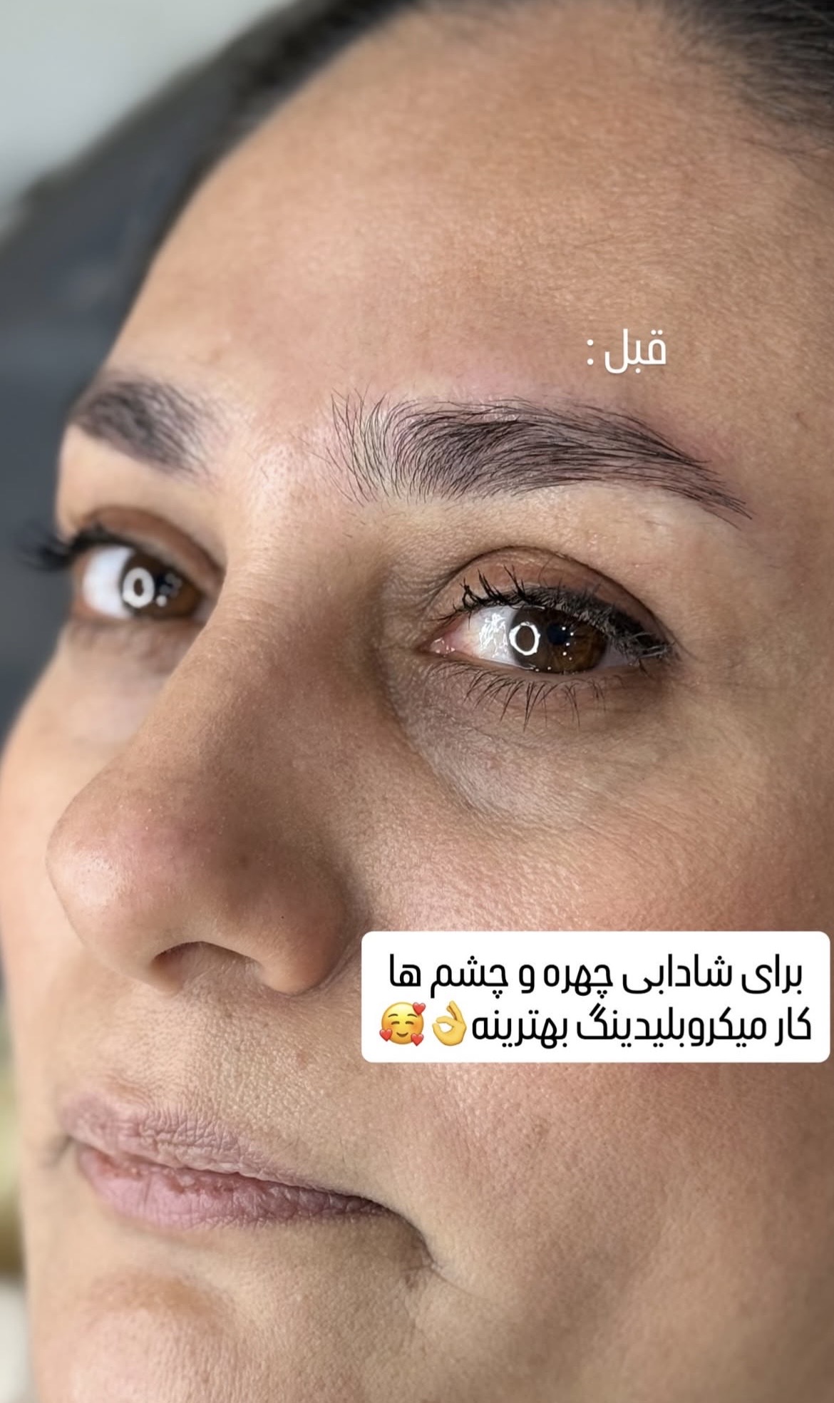 مدل میکروبلیدینگ 