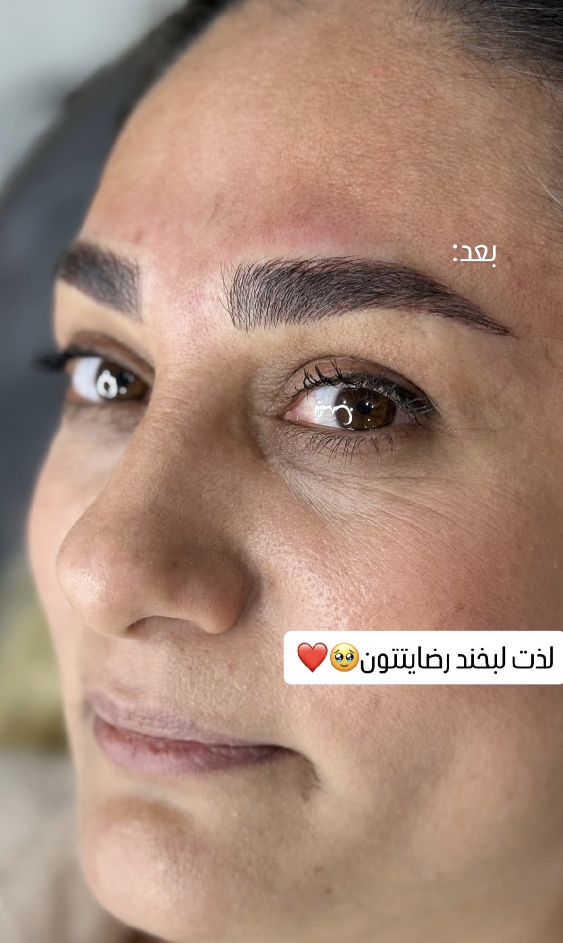 مدل میکروبلیدینگ 